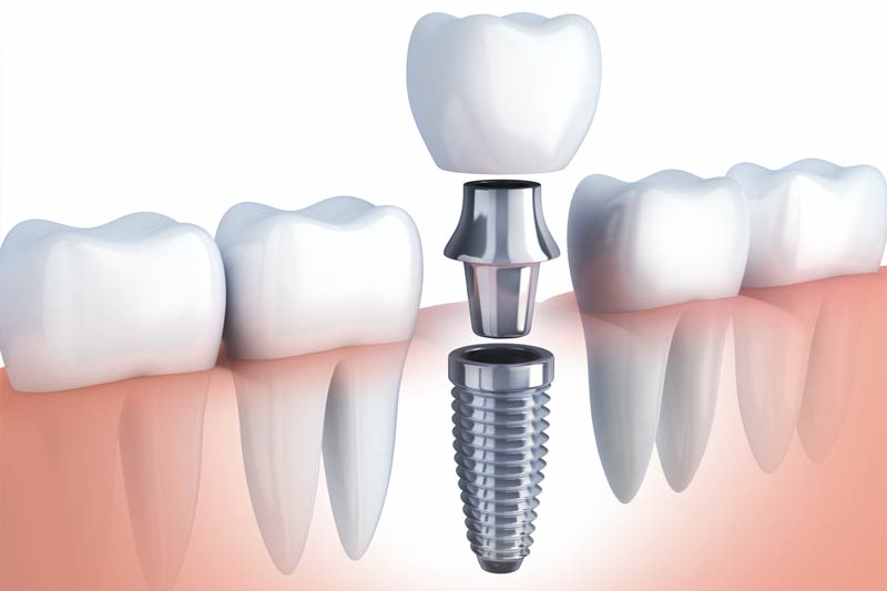 Implants Dentist in Elkhorn